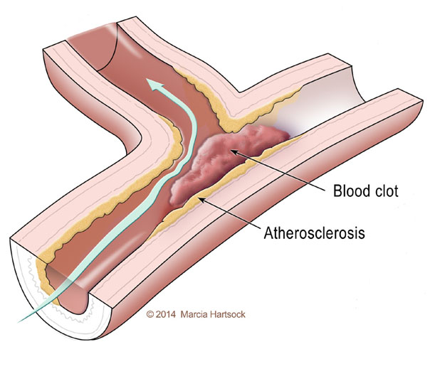 Ischemic Stroke